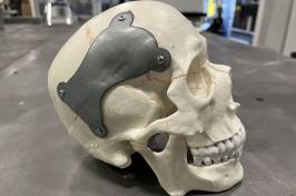 A model skull with a large metal "patch" on it